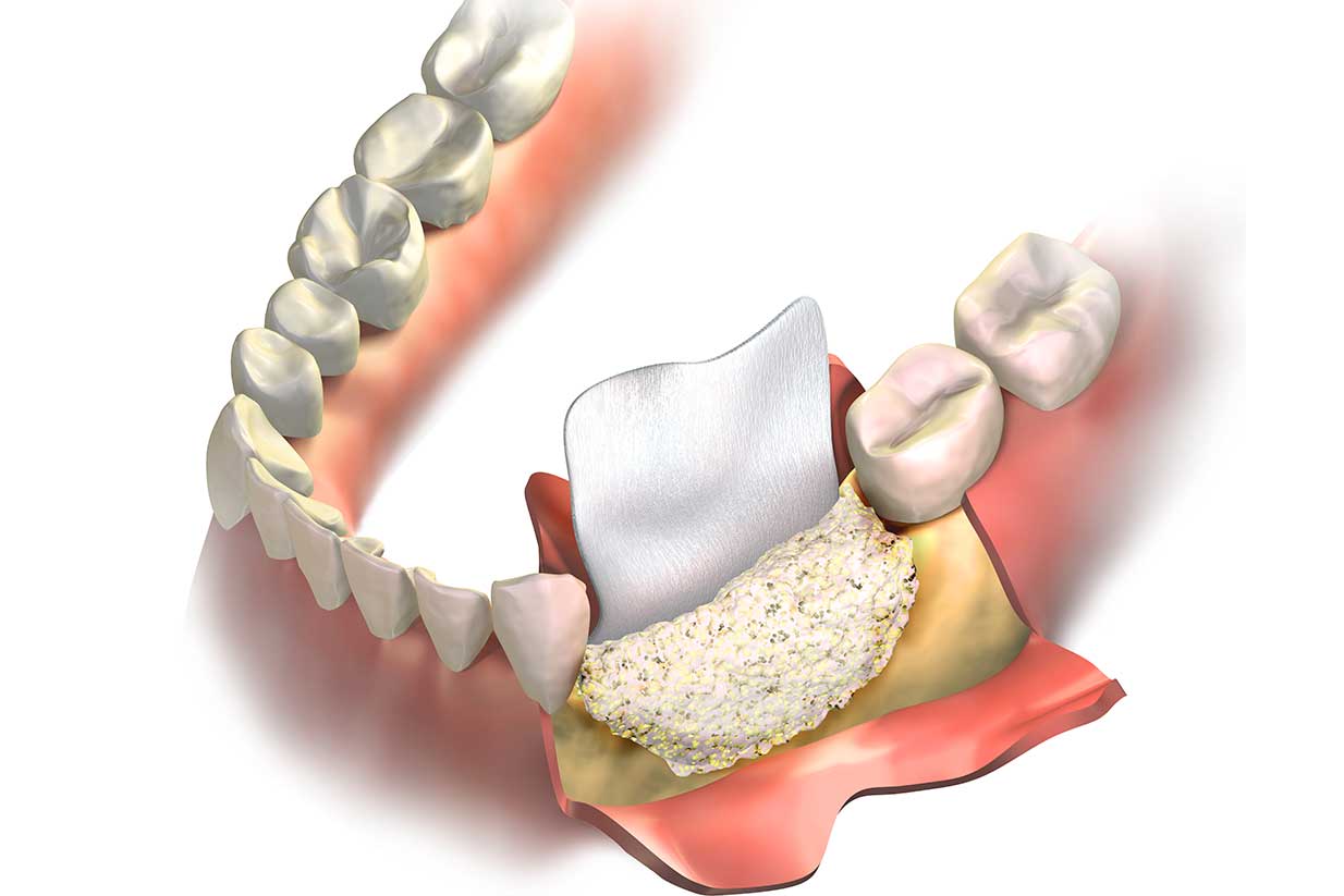 Bone Grafting | West Calgary Periodontics